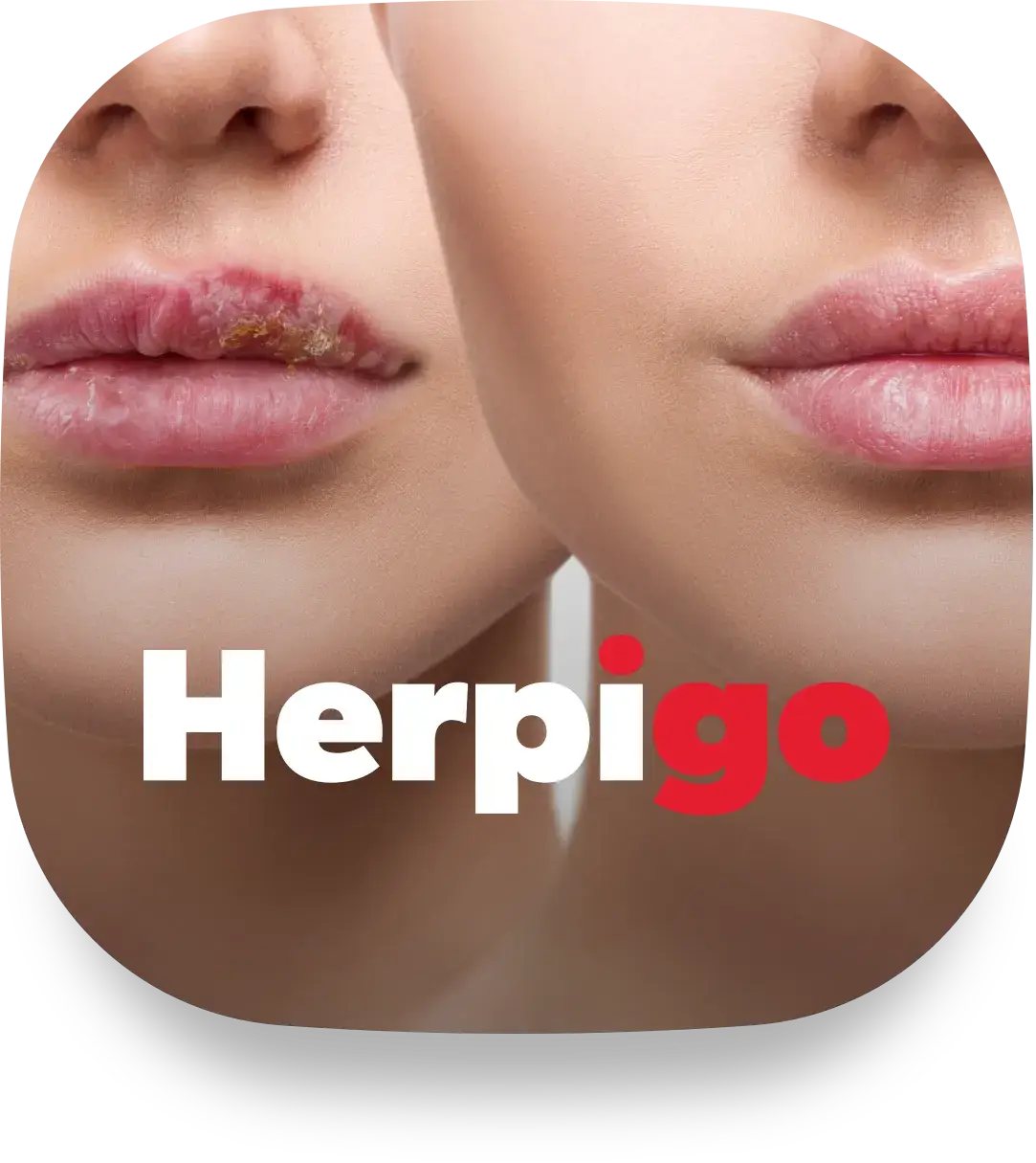 Herpigo Body